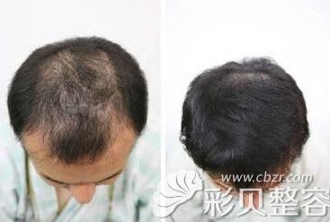 北京八大处头发种植案例效果对比图