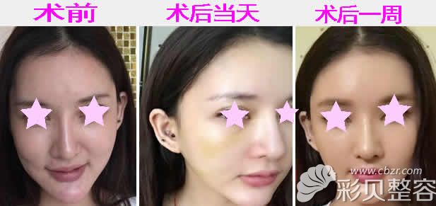 南京施尔美李彤彤面部年轻化恢复过程图
