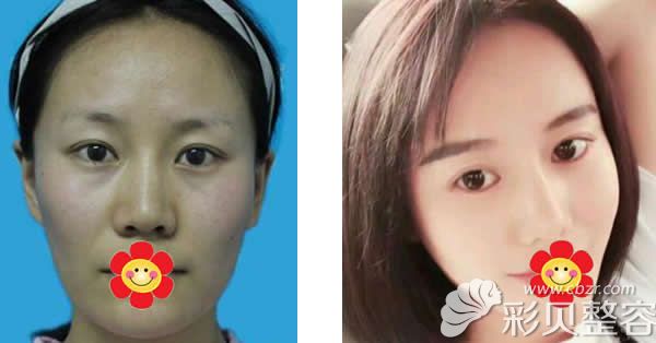 北京榛红绍国面部吸脂+综合隆鼻效果案例