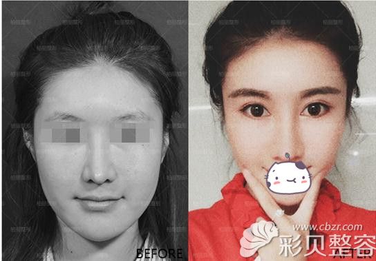 李劲良膨体隆鼻修复案例 李劲良膨体隆鼻修复案例