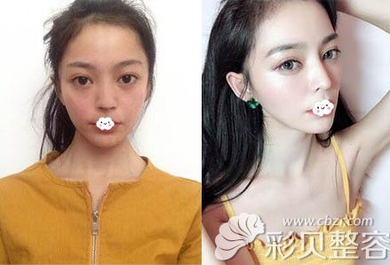 郑州医德佳整形医院胡斌鼻综合隆鼻案例