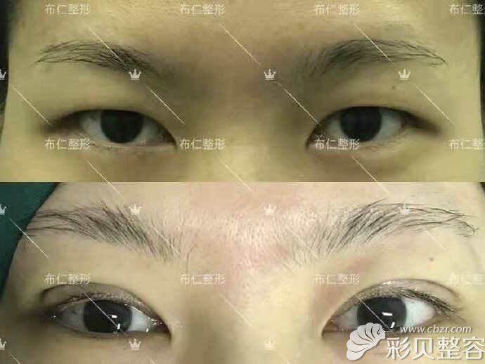 北京八大处布仁医生开扇形双眼皮对比案例