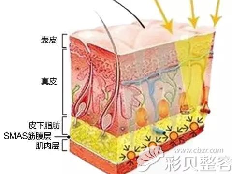 在SMAS层进行提拉皮肤以达到紧致效果