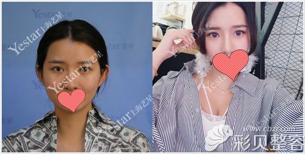上海艺星李建兵为爱美者做假体隆鼻术后45天效果展示