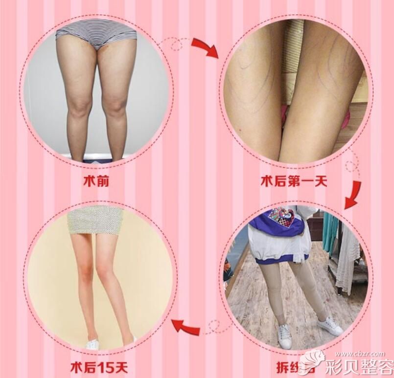 北京知音整形吸脂瘦大腿案例效果恢复图