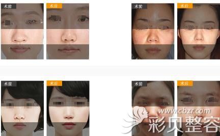 李劲良医生的鼻翼缩小案例