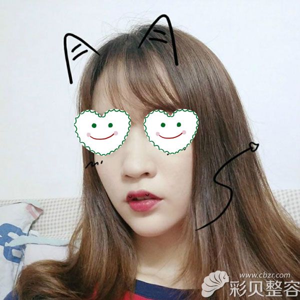 没做隆鼻手术之前的我