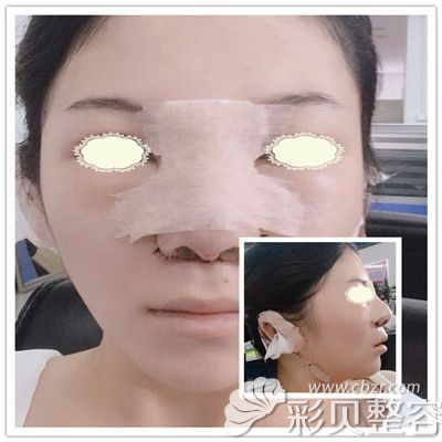 廖伟龙医生耳软骨隆鼻术后第二天图片展示