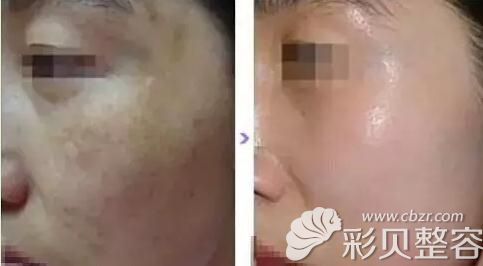 皮秒激光你还想知道的术后效果