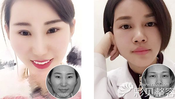 南京美贝尔医院黄名斗医生全切双眼皮+全脸脂肪填充案例
