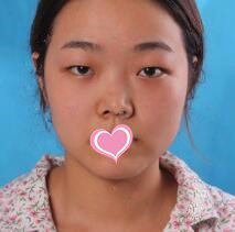 我在北京伊美康割双眼皮效果让老妈有了面部脂肪填充念头