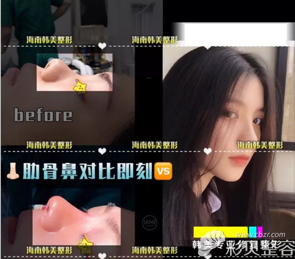 海南韩美周文亮医生自体肋软骨隆鼻+硅胶假体隆鼻案例
