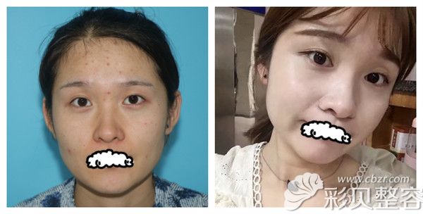 延安大学咸阳医院医疗美容整形科黄蕾医生果酸换肤术后对比照