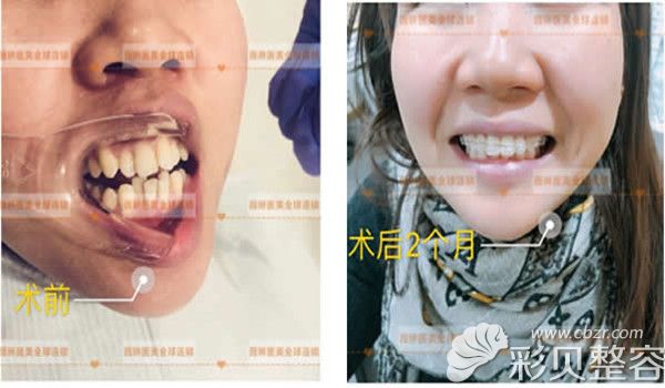 北京薇琳医美张建峰半隐形牙齿矫正术后对比图