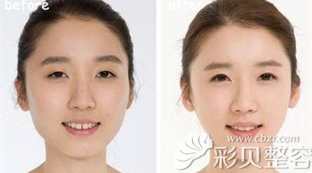 根据求美者脸型，塑造合适的下巴弧线