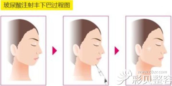 玻尿酸注射丰下巴过程图 玻尿酸注射丰下巴过程图