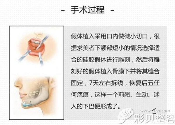 假体垫下巴手术方法展示图 假体垫下巴手术方法展示图