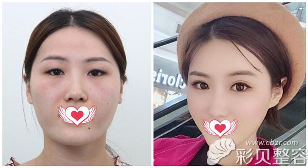 陈诚做全切双眼皮+开眼角案例效果