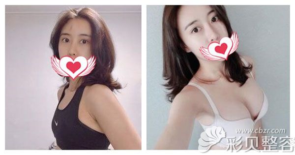 兰州韩美整形自体脂肪丰胸真实案例