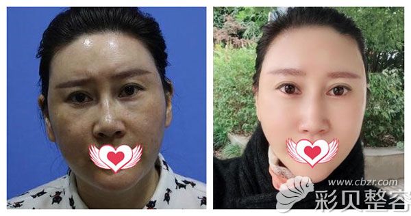 林剑超做面部线雕效果对比图