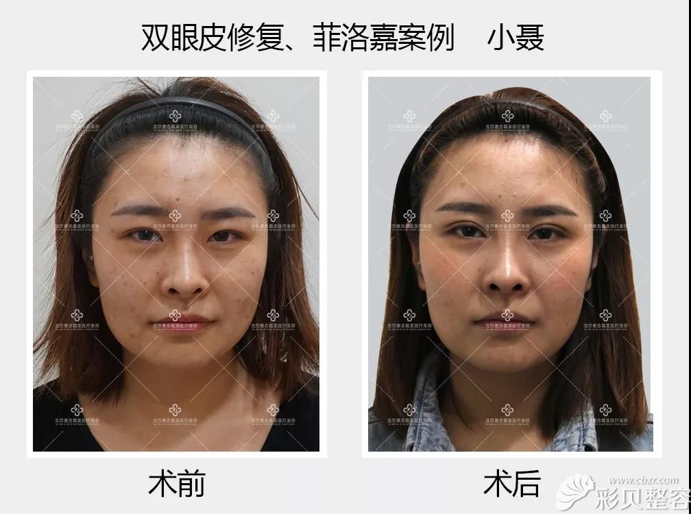 北京惠合嘉美双眼皮修复、案例