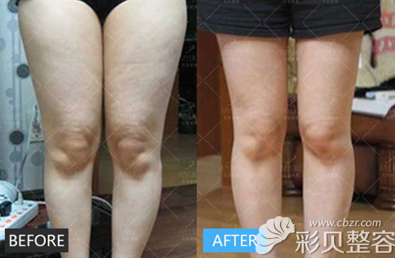 美莱整形医院腿部吸脂对比
