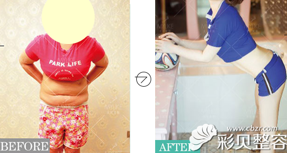 北京美莱整形院腹部吸脂前后