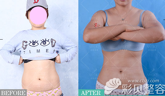 北京美莱医疗美容腰腹吸脂案例