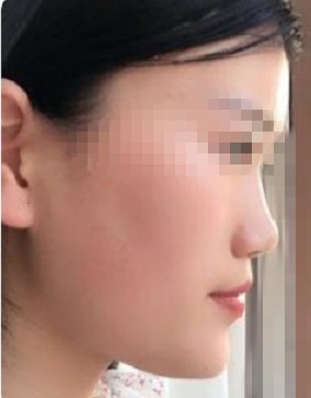 记录我在韩国will做的硅胶假体+耳软骨隆鼻手术过程
