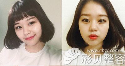 韩国新帝瑞娜双眼皮手术术后20天