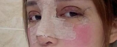 北京万达行医疗整形割双眼皮+隆鼻综合手术后让我秒变女神