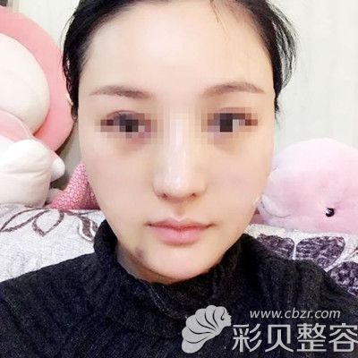 韩国迪美丽做面部吸脂+魔力V线条手术术后三天