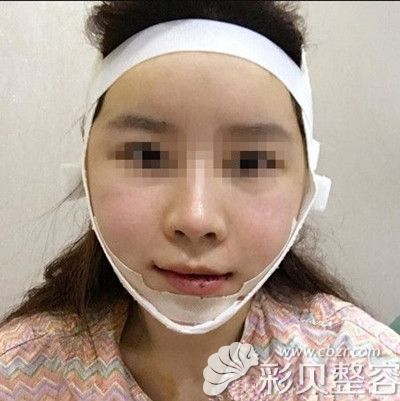 韩国拉菲安做颧骨缩小+长曲线下颌角手术术后第二天