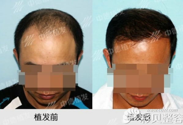北京中德男士头顶加密植发9个月效果案例