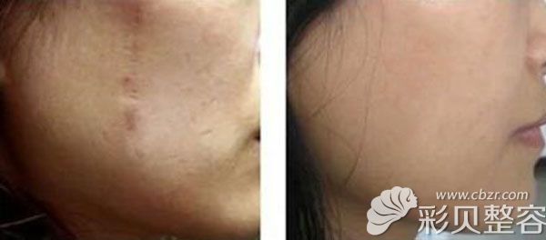 中信惠州整形美容科脸部凹陷疤痕修复前后对比效果图