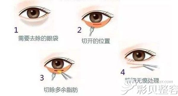 割眼袋会有什么后遗症吗 割眼袋会有什么后遗症吗