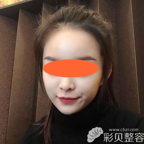 我在北京东方和谐做完自体脂肪填充全脸术后第40天恢复效果