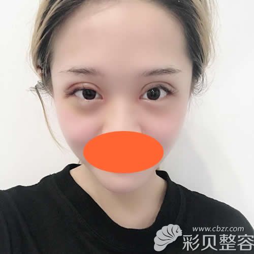 找南京华韩奇致章宏伟割双眼皮+开眼角术后第7天