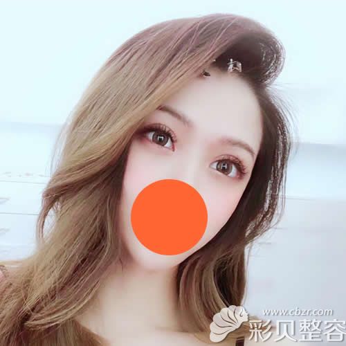 找南京华韩奇致章宏伟割双眼皮+开眼角术后一个月恢复效果