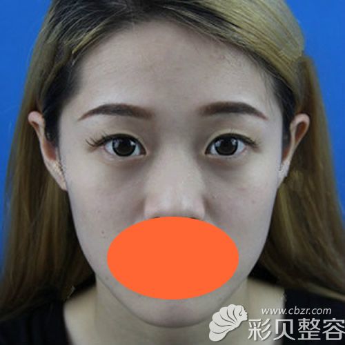 找南京华韩奇致章宏伟割双眼皮+开眼角术前