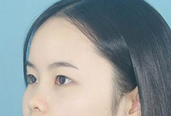 找长沙法莱丽吴倩做全切双眼皮40天的恢复效果有种欧式风格