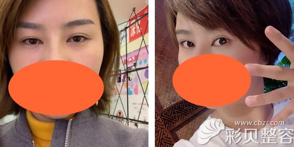 北京美莱宫风勇切眉手术真人<span style=