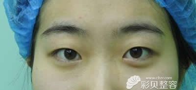 去广州高尚医学美容中心找余文林院长割双眼皮术前