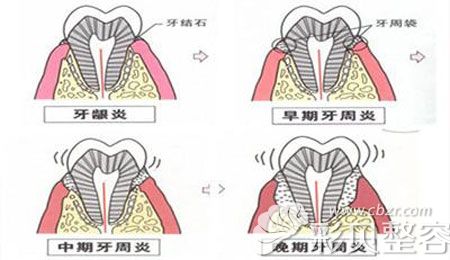 牙周炎和牙龈炎具体区别介绍