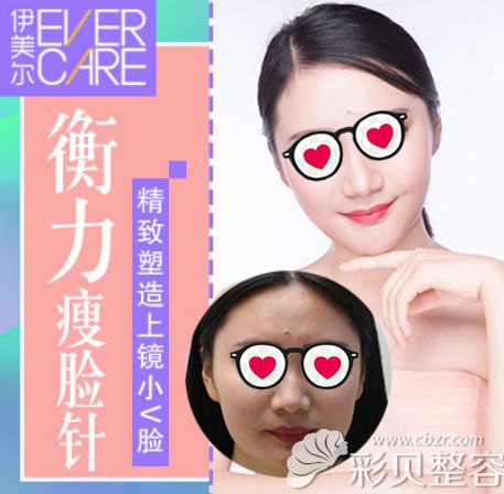 哈尔滨伊美尔打瘦脸针前后效果对比图