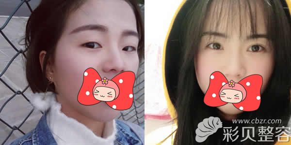 西宁时光整形王双余主任切开双眼皮+开眼角+下睑真人案例效果