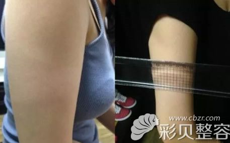 手臂抽脂五个月后的恢复效果