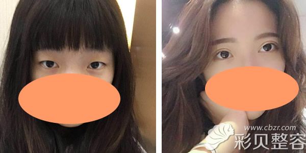 韩国菲斯莱茵李真秀大眼综合前后对比案例图
