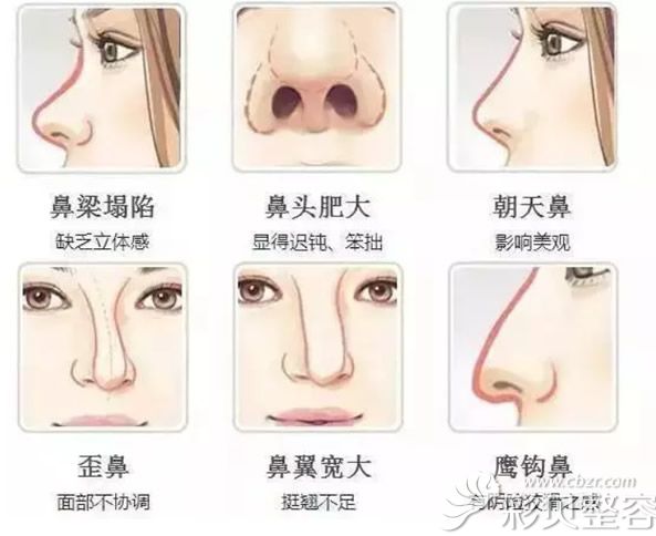 线雕隆鼻的危害和好处有哪些 线雕鼻2年后会怎样 整容资讯 彩贝整容网