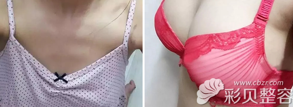 假体隆胸350cc真人案例效果图